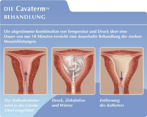 cavaterm behandlung